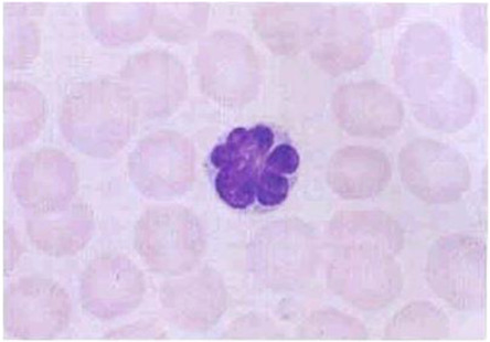 バーナード・スーリエ症候群 (BSS) の症状